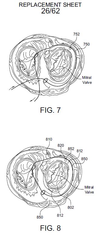 Mitral Valve Prosthesis — Annular Assembly