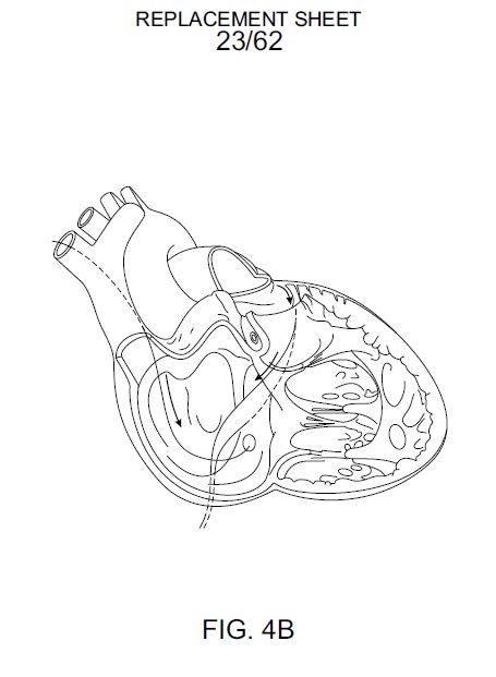 Cardiac Cross-Section — Catheter Delivery Path