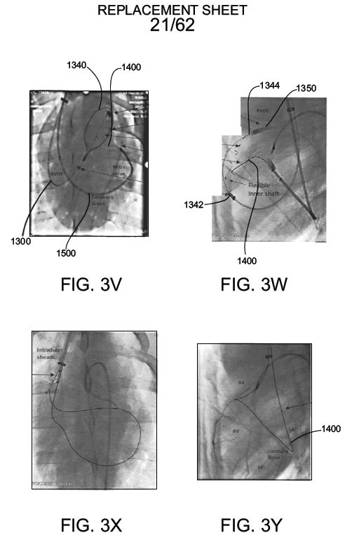 Fluoroscopic Views — In-Vivo Catheter Guidance